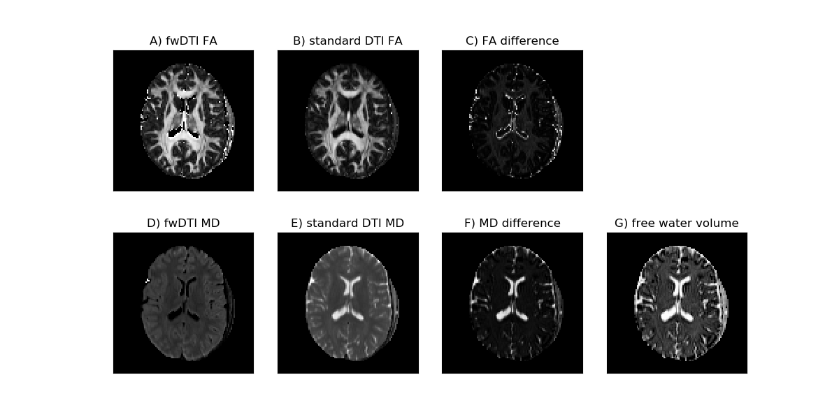 ../_images/In_vivo_free_water_DTI_and_standard_DTI_measures.png